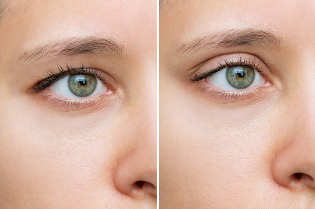 Close up of young caucasian woman's face with drooping upper eyelid before and after blepharoplasty