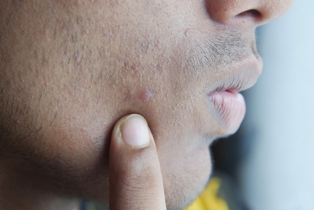 Close up of young man face with skin problem