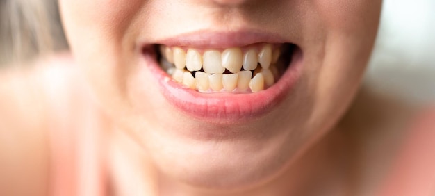 Close up of young woman's face with crooked teeth Teeth before install braces Teeth need ortodonti