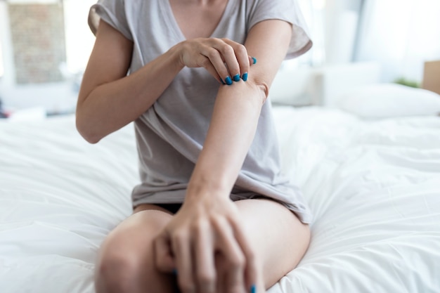 Close up of young woman sitting on the bed while scratching her arm. Psoriasis concept.