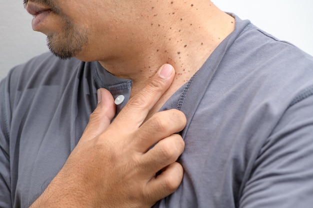 Closed up the Skin Tags or Acrochordon on neck man on white background.