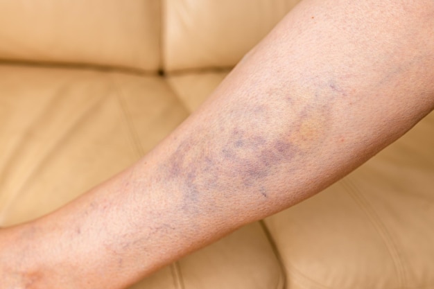 Closeup of a bruise on a womans leg A bruised leg