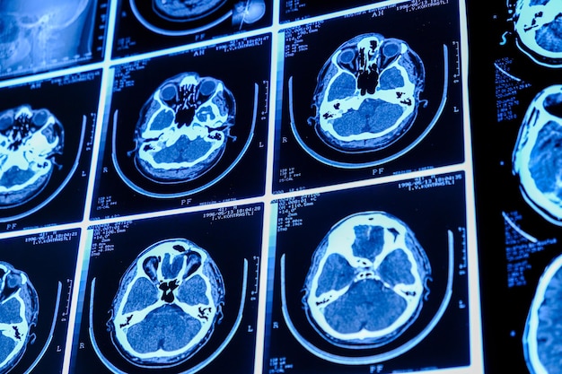 Closeup of CT scan with brain Medicine science and education MRI brain background