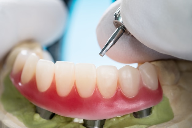 Closeup/ Dental implants supported overdenture