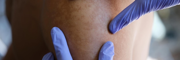 Photo closeup of dermatologist examining patients skin pigmentation in medical clinic doctor looks at