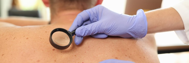 Photo closeup of doctor with magnifier examining pigmentation on male patient back surgeon looking at