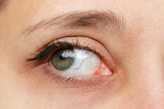 Closeup of female eye with red inflamed and dilated capillaries Keratitis dry eye syndrome