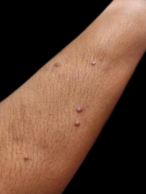 Photo closeup of a forearm with a staphylococcal skin infection