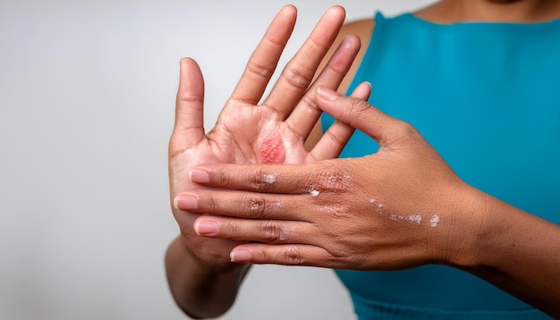 Photo closeup of a hand affected by contact dermatitis