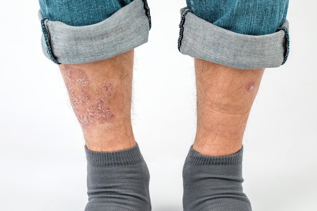 Closeup of the legs of a man suffering from chronic psoriasis on a white background