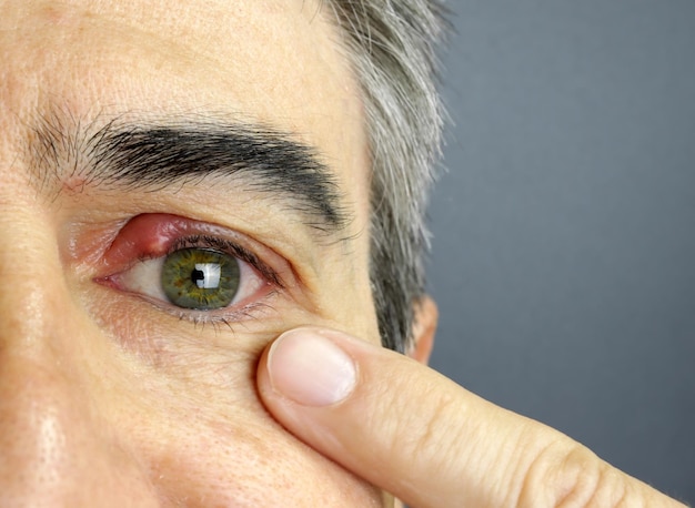 Closeup of a man eye stye Ophthalmic hordeolum disease chalazion