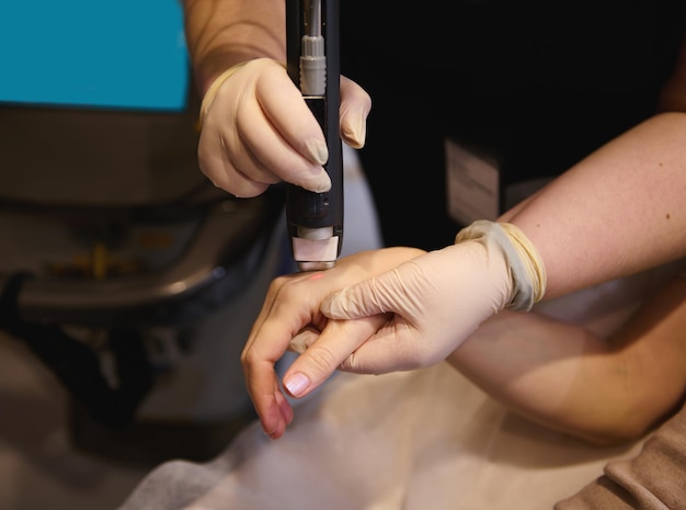 Closeup of professional removal of pigment spots and hair from the hands using a medical laser in a spa clinic