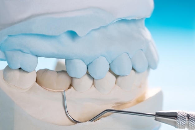 Closeup / Prosthodontics or Prosthetic / Single teeth crown and bridge equipment model express fix restoration.