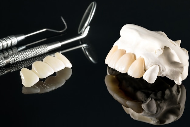 Closeup / Prosthodontics or Prosthetic / Tooth crown and bridge implant dentistry equipment and model express fix restoration.