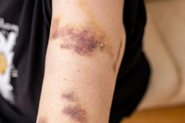 Photo closeup purple bruised on the arm of human from accident