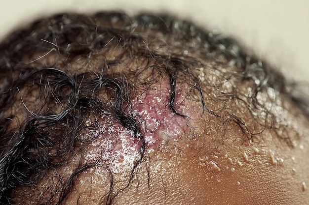 Photo closeup of a scalp with a scar and sweat