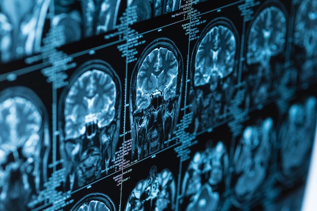 Closeup series of MRI images of head and brain, magnetic resonance imaging scan, world cancer day concept