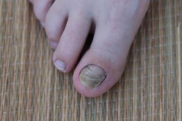 Closeup shot of fungus on the toenail