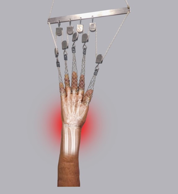 Closeup of skeleton traction with frame in a patient with fracture of the wrist after the accident Fracture hands use traction to immobilize before going to surgery Medical and insurance concept