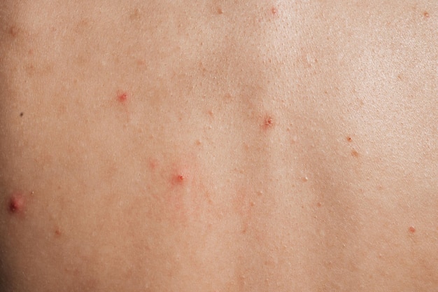 Closeup of the skin of a young girl with problems Pimples acne pores scars Natural skin without filters