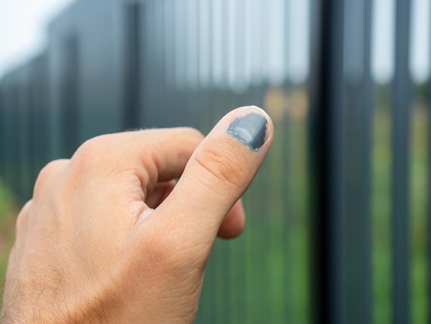 Closeup of a thumped thumb Blurred background Injury at work bruise hematoma Selective focus