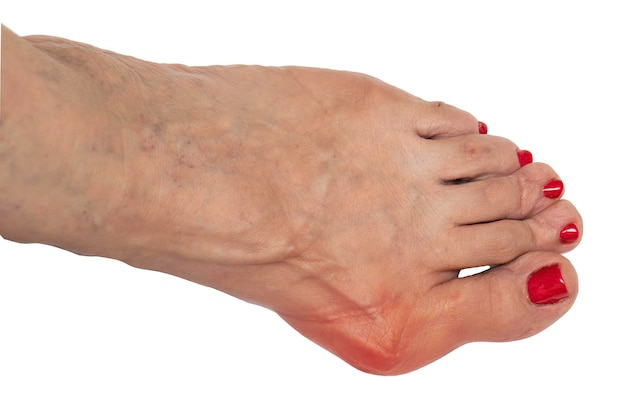 Photo a closeup view on the bare foot of an elderly woman showing a painful and swollen case of bunion