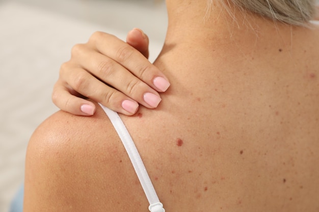 Closeup view of womans body with birthmarks indoors