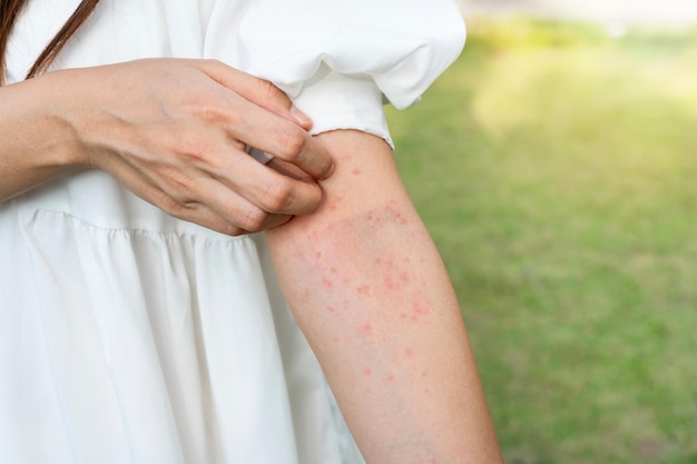 Closeup of woman hand scratching her skin itchy Allergic rash dermatitis eczema skin insect food allergy health care concept