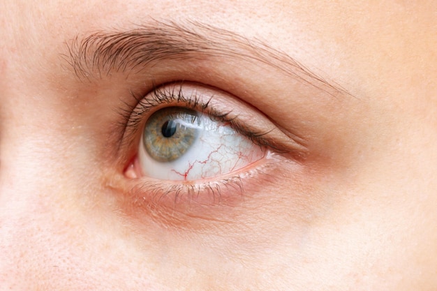 Closeup of womans eye with red inflamed and dilated capillaries Dry eye syndrome trauma uveitis