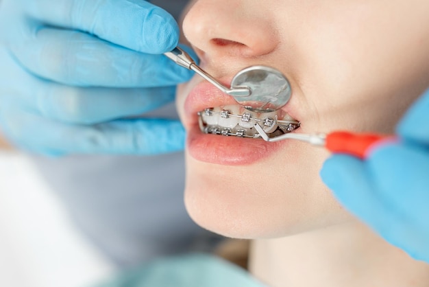 Closeup of young woman with braces dental checkup