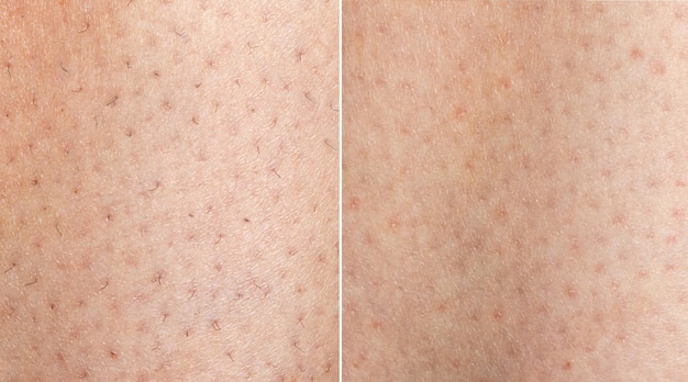 Photo collage before and after hair removal image before and after leg hairs removal concept close up ph