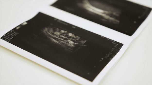 Photo collection of images from ultrasound scan examination action close up of monochrome images of