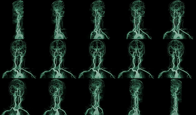 Collection MRA Brain or Magnetic resonance angiography MRA of the cerebral artery and common carotid artery AP and Lateral View to evaluate them stenosis and stroke disease green tone process