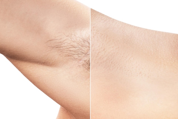 Comparison of female armpit after hair removal