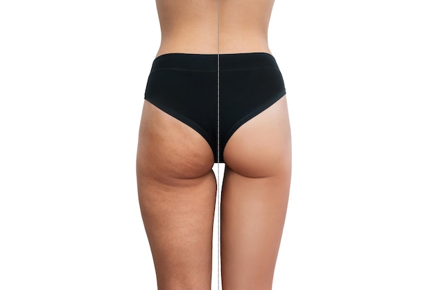 Comparison of a young woman's thighs and buttocks with cellulite before and after treatment