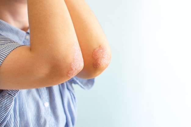 Concept Psoriasis dermatology close-up on the logs, on a blue background. Skin diseases and care.