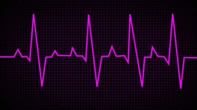 Coronary artery disease Electrocardiogram show ST elevation myocardial infarction STEMI pattern Heart attack Ischemic Angina pectoris Chest pain ECG EKG Medical health care