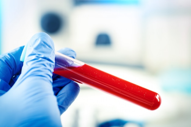 Coronavirus in Lab. Scientist hold Blood Test.