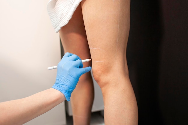 cosmetologist doctor makes markings of the patient's legs before the coolsculpting procedure