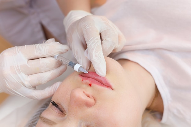 The cosmetologist pushed the needle from the syringe into the girl's lips to the very base trying to evenly inject hyaluronic acid. The blood droplets act as a result of the previous injections