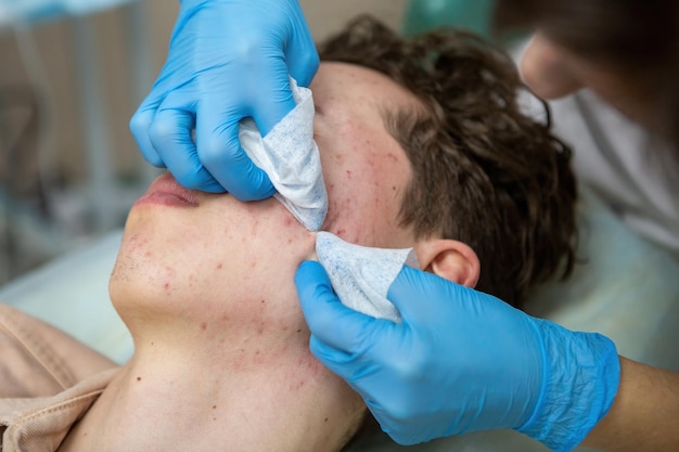 A cosmetologist treats acne in a teenage boy whose face is covered with pimples and red spots