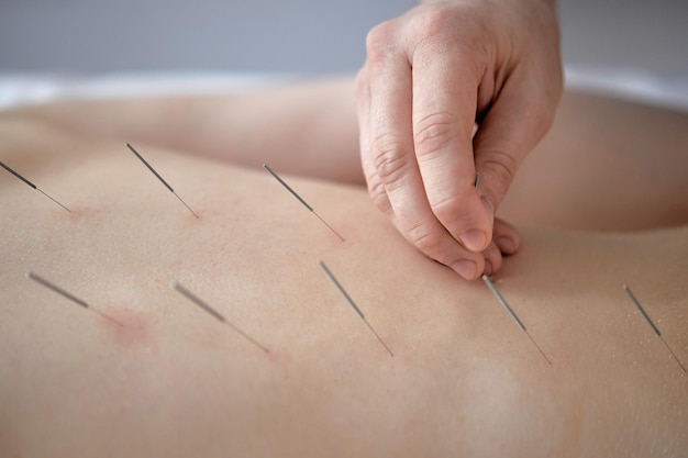 Cropped Acupuncturist treats patient's illness with acupuncture at special points on back