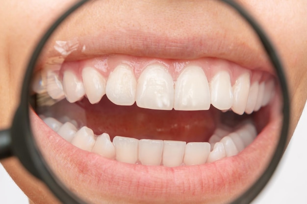 Cropped shot of a young woman with white spot on the tooth enamel enlarged in magnifying glass