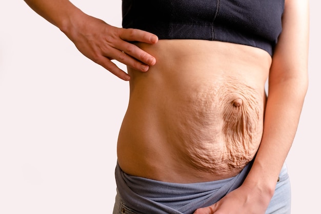 Cropped woman dressed in black top and blue jeans diastasis and umbilical hernia after pregnancy