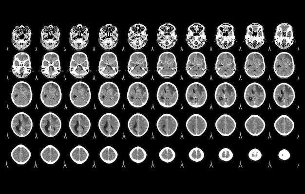 CT Brain History Headache Finding mass with illdefined margin and surrounding edema at Lt frontal lobe