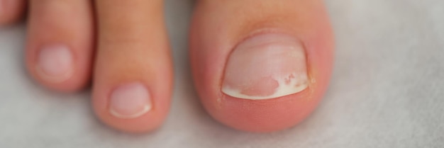 Damaged toenail close up shallow depth of field toenails desease and healthcare of body concept