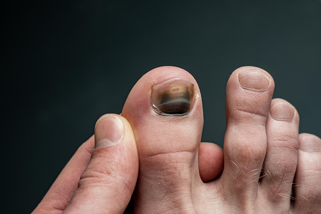 Damaged toenail Hematoma on the thumb