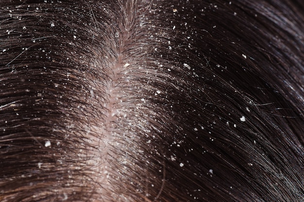 Dandruff on woman's dark hair