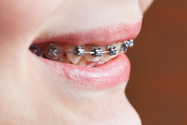 Dental braces on teeth of upper jaw close up