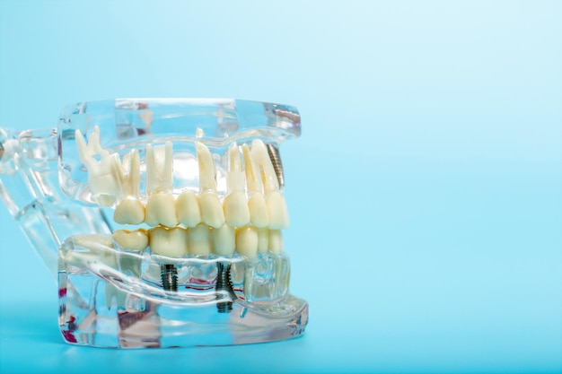 Dental jaw model over blue background Dentist dental prosthetic teeth gums roots closeup